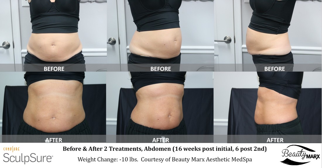 Before and After SculpSure Body Contouring Pictures at Beauty Marx in Doylestown